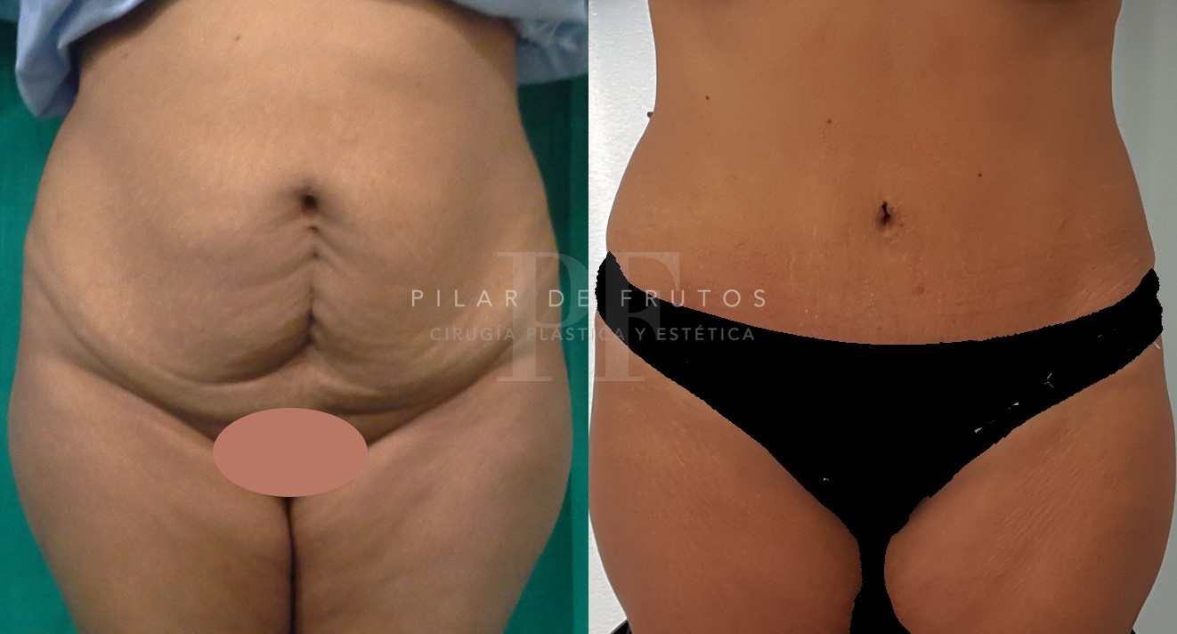 fotos de abdominoplastia antes y despues