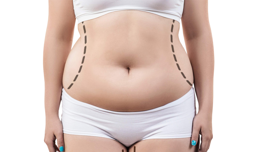 ¿Qué es la Liposucción Vaserlipo?