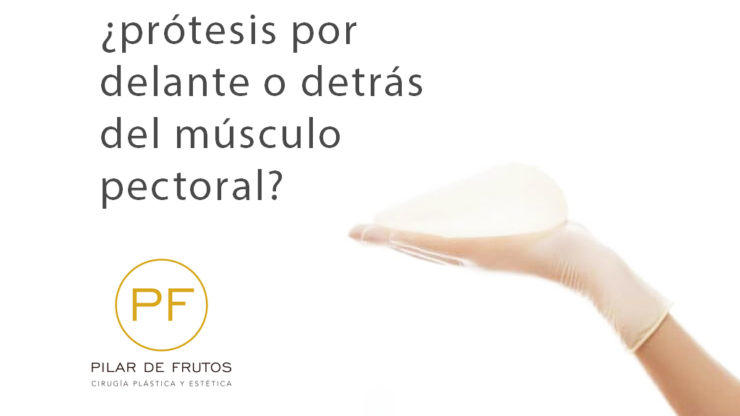Prótesis mamarias ¿por delante o detrás del músculo pectoral?