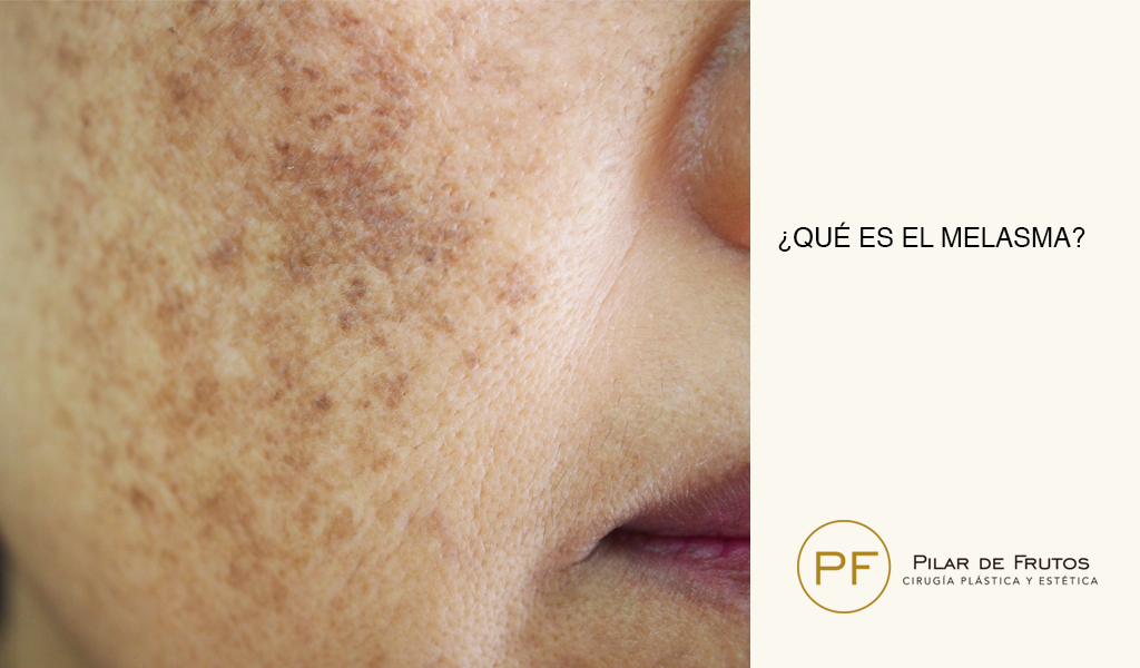 Qué es el melasma y cómo tratarlo