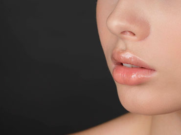 Aumento de labios con Ácido Hialurónico. Pilar de Frutos