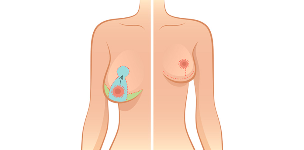 Mastopexia, elevación de pecho. Cirugia mamaria. Pilar de Frutos