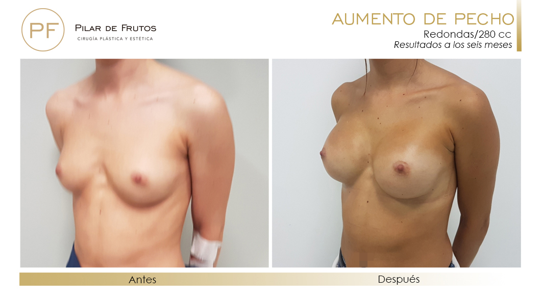 foto de aumento de mamas resultados