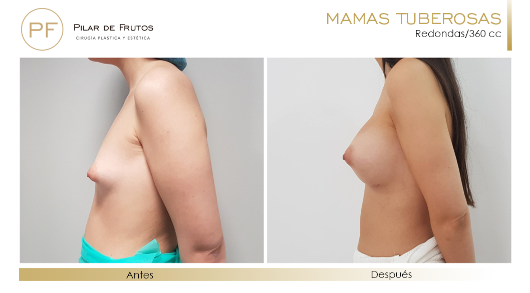 Fotos de mamas tuberosas: antes y después. Cirugía mamaria. Pilar de Frutos