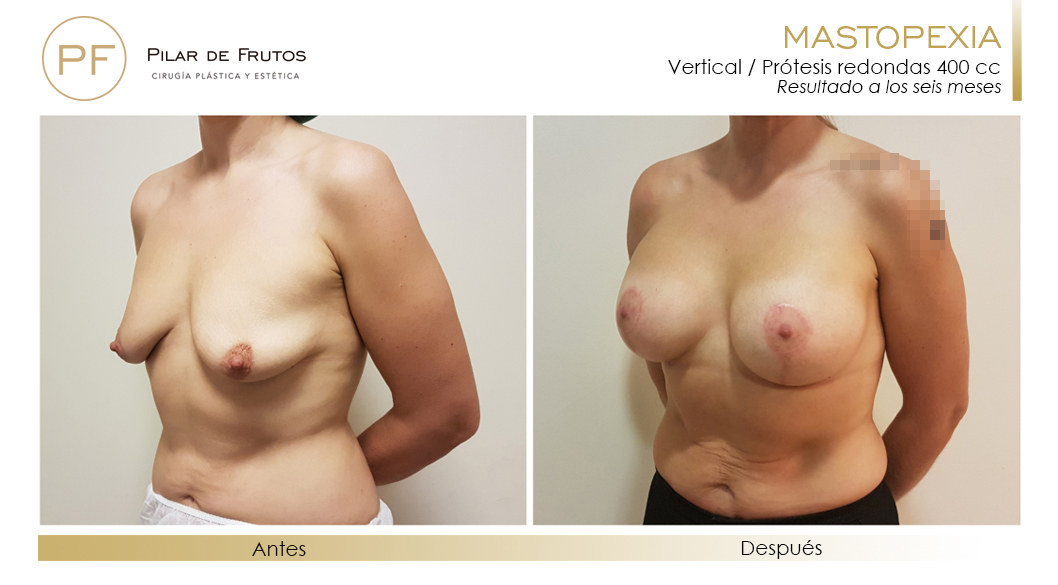 Elevación: antes y después. Cirugía mamaria. Pilar de Frutos