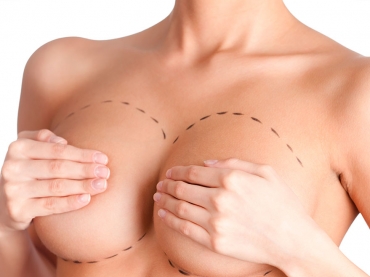 Las Preguntas frecuentes más repetidas en cirugía mamaria