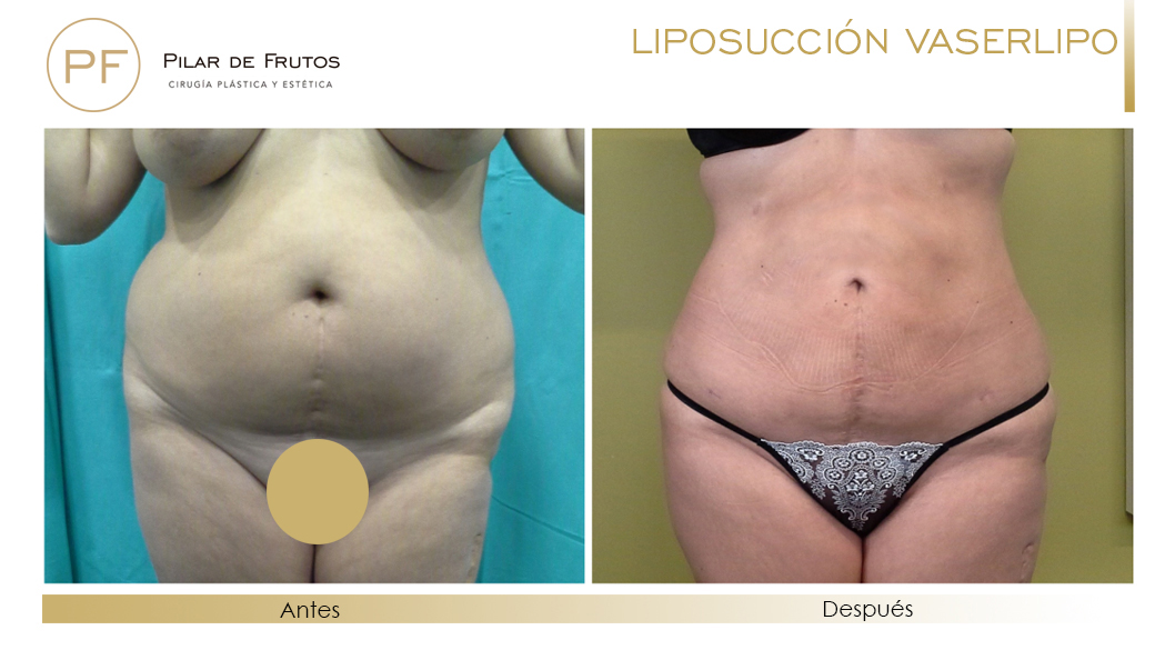Fotos de Lipoescultura: antes y después