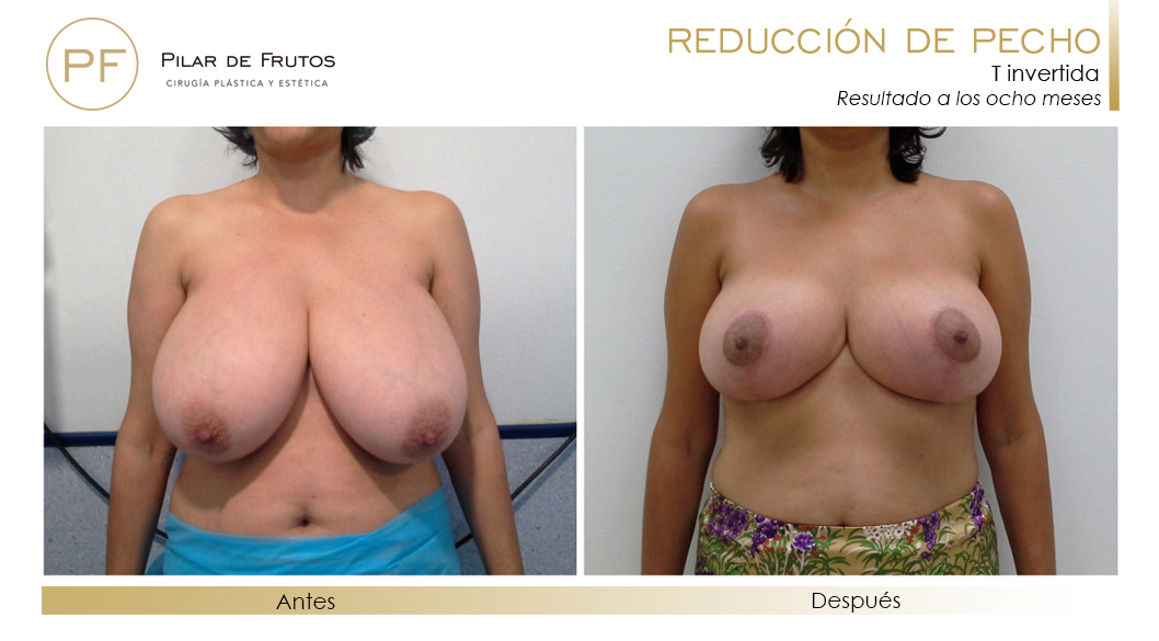 Reducción de pecho: Antes y después. Cirugía mamaria. Pilar de Frutos