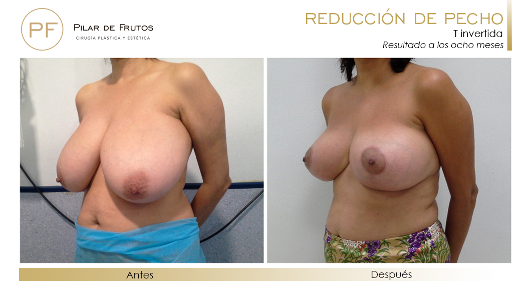 Reducción de senos: Antes y después. Cirugía mamaria. Pilar de Frutos