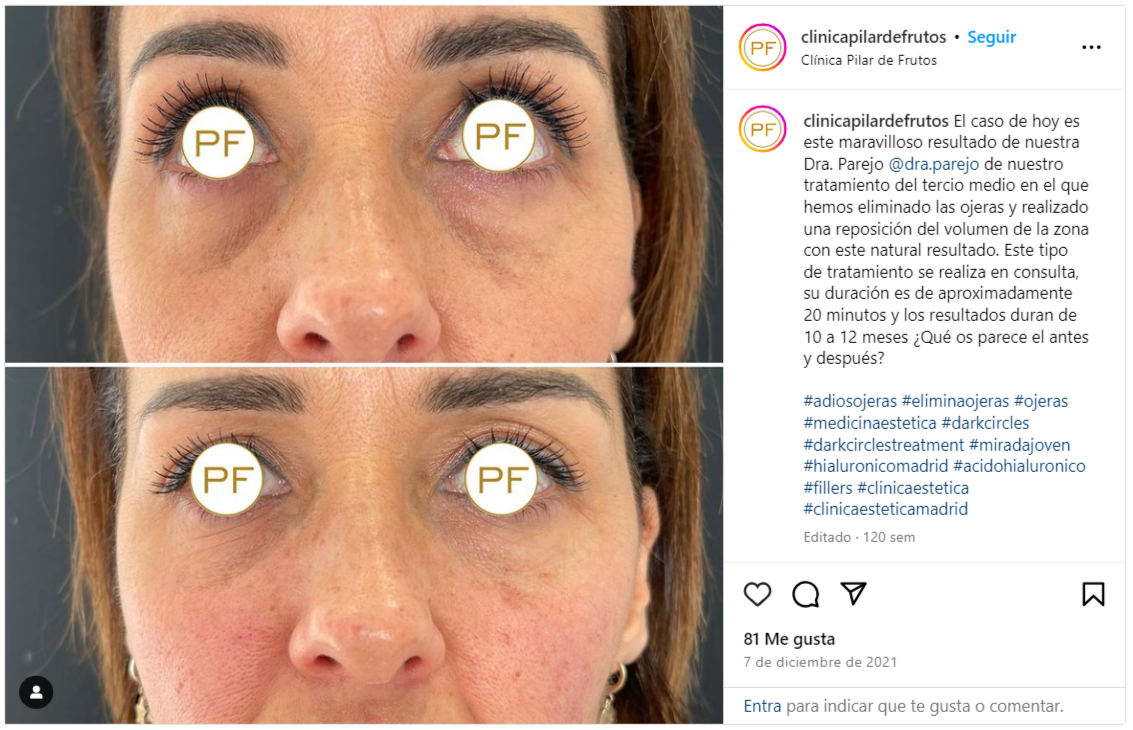 ojeras antes y despues