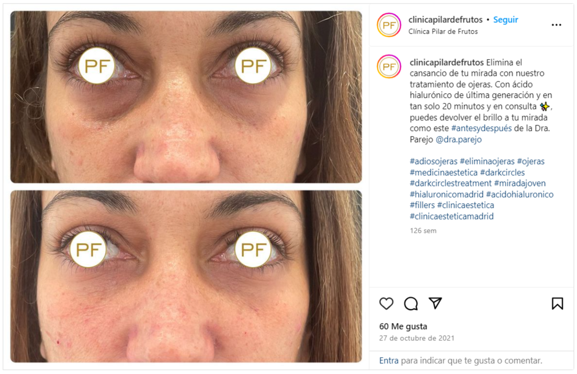ojeras antes y despues