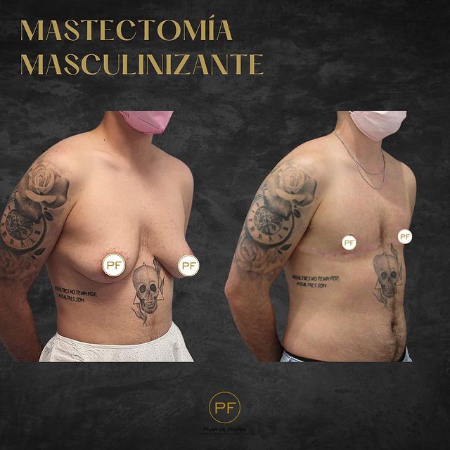 masectomia masculinizante