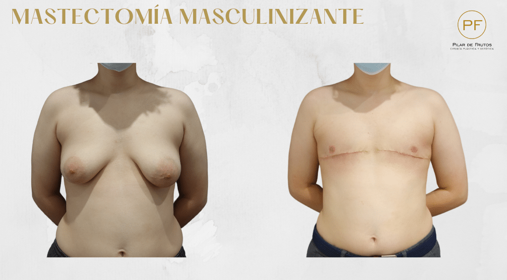 Mastectomía trans. Pilar de Frutos