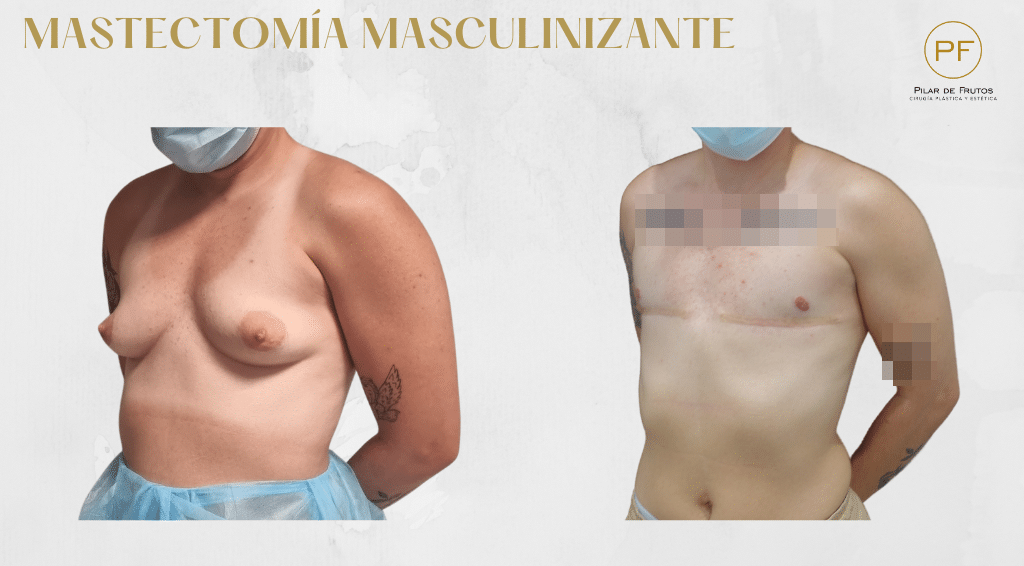 Mastectomía trans. Pilar de Frutos