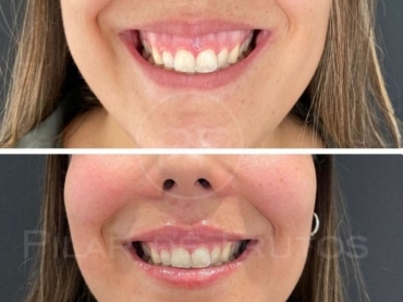 Sonrisa Gingival: lo que ningún dentista te cuenta