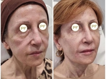 Refreshing facial para tener una piel radiante