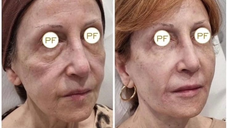 Refreshing facial para tener una piel radiante