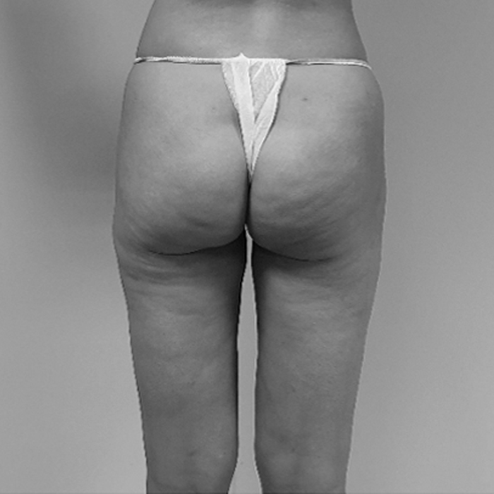 Elevacion de gluteos con renuvion antes y despues