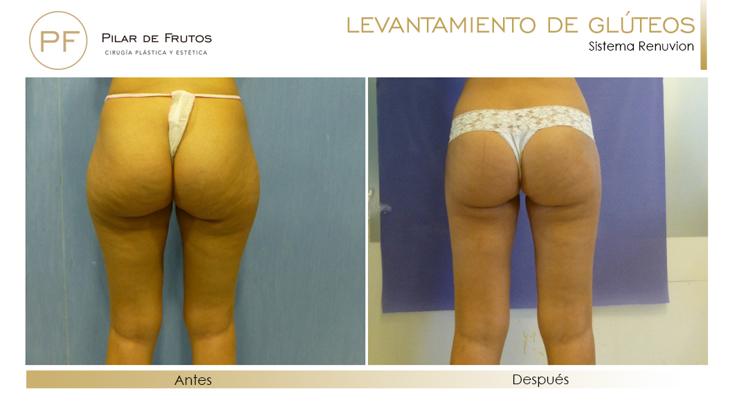 Elevacion de gluteos con renuvion antes y despues Elevacion de gluteos con renuvion antes y despues