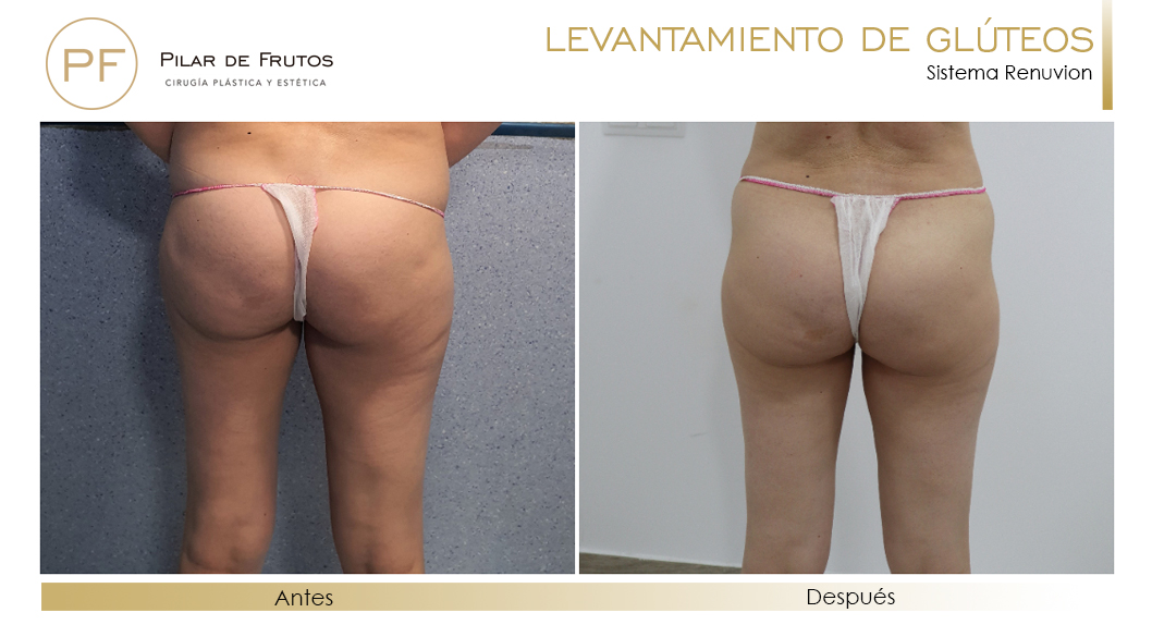 Elevacion de gluteos con renuvion antes y despues Elevacion de gluteos con renuvion antes y despues