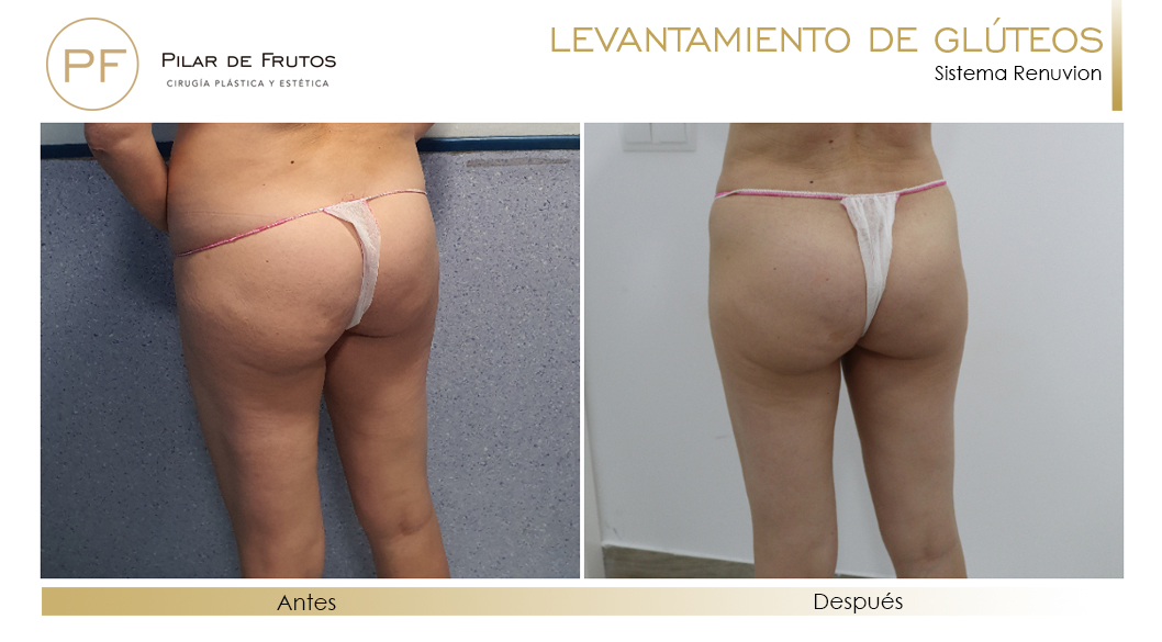 Elevacion de gluteos con renuvion antes y despues Elevacion de gluteos con renuvion antes y despues