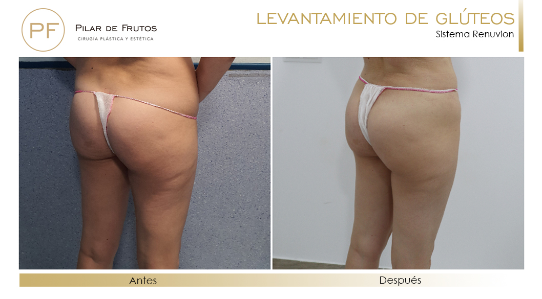 Elevacion de gluteos con renuvion antes y despues Elevacion de gluteos con renuvion antes y despues