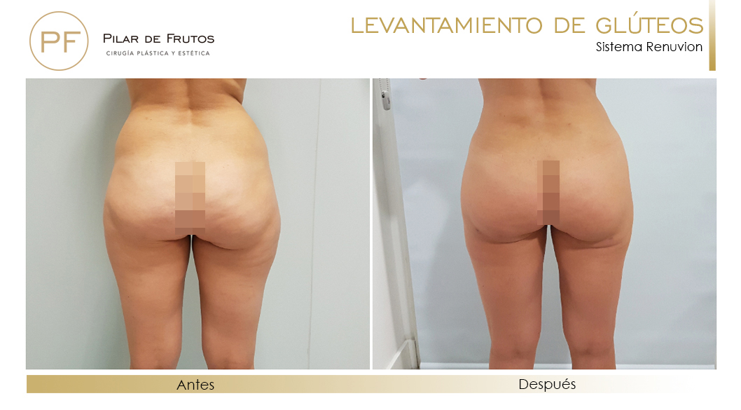Elevacion de gluteos con renuvion antes y despues Elevacion de gluteos con renuvion antes y despues