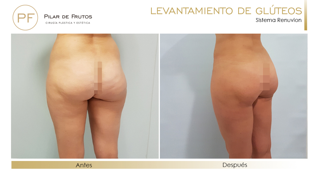 Elevacion de gluteos con renuvion antes y despues Elevacion de gluteos con renuvion antes y despues