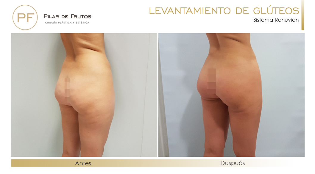 Elevacion de gluteos con renuvion antes y despues Elevacion de gluteos con renuvion antes y despues