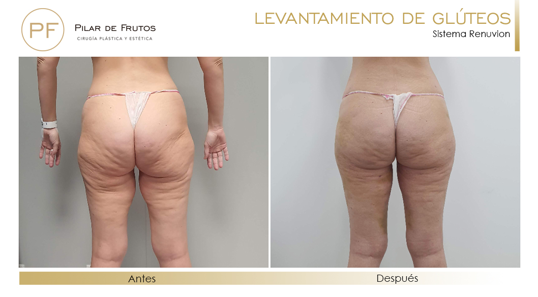 Elevacion de gluteos con renuvion antes y despues Elevacion de gluteos con renuvion antes y despues