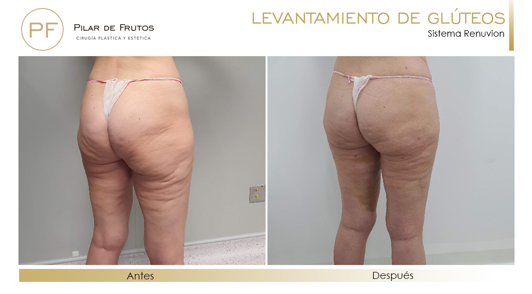 Elevacion de gluteos con renuvion antes y despues Elevacion de gluteos con renuvion antes y despues