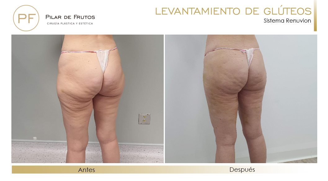 Elevacion de gluteos con renuvion antes y despues Elevacion de gluteos con renuvion antes y despues