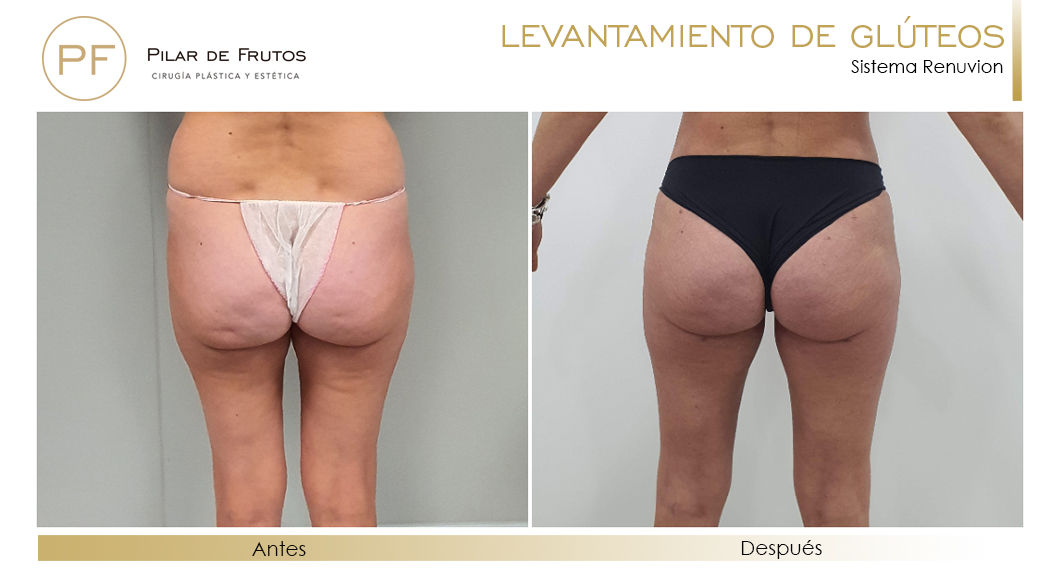 Elevacion de gluteos con renuvion antes y despues