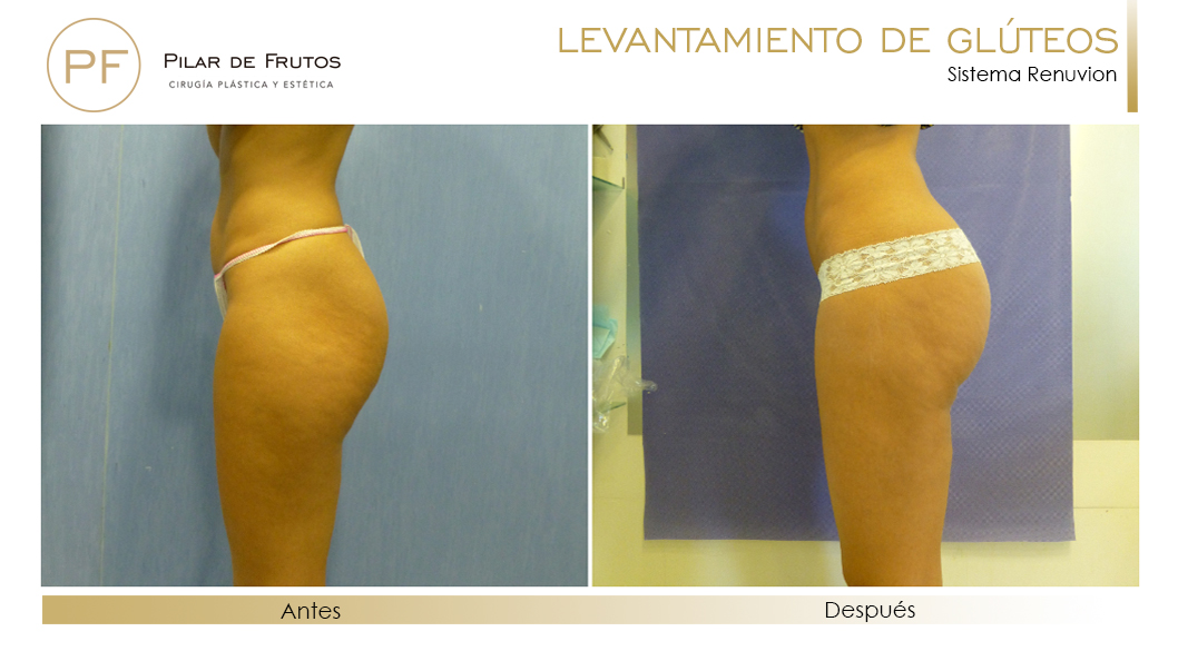 Elevacion de gluteos con renuvion antes y despues Elevacion de gluteos con renuvion antes y despues