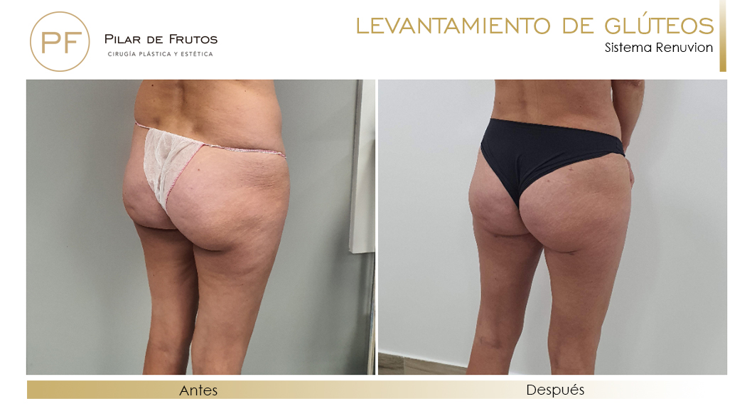 Elevacion de gluteos con renuvion antes y despues Elevacion de gluteos con renuvion antes y despues