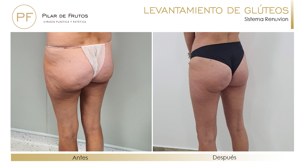 Elevacion de gluteos con renuvion antes y despues Elevacion de gluteos con renuvion antes y despues