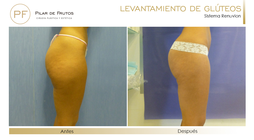 Elevacion de gluteos con renuvion antes y despues Elevacion de gluteos con renuvion antes y despues
