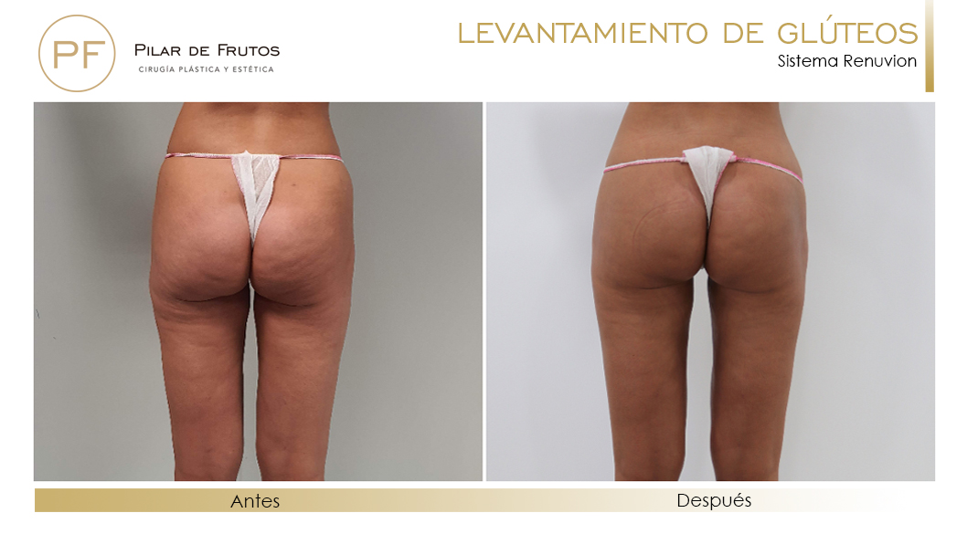 Elevacion de gluteos con renuvion antes y despues