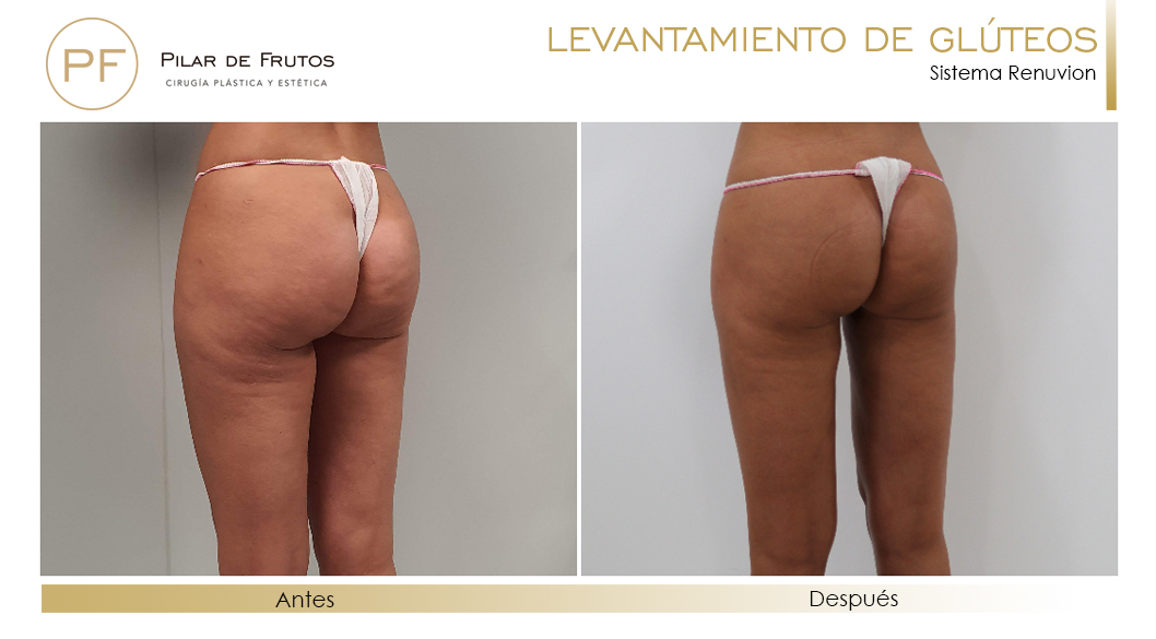 Elevacion de gluteos con renuvion antes y despues Elevacion de gluteos con renuvion antes y despues