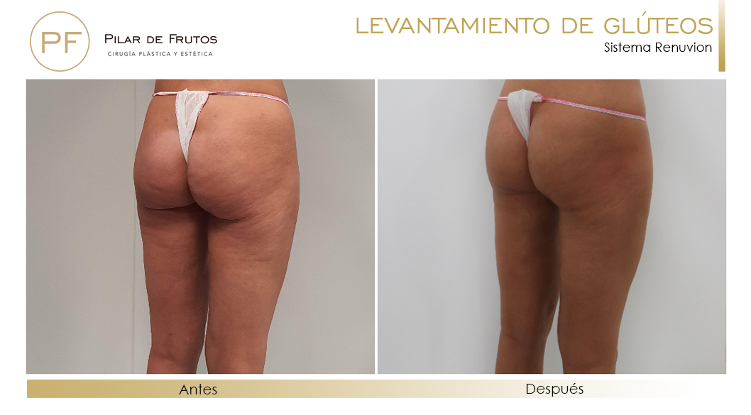 Elevacion de gluteos con renuvion antes y despues Elevacion de gluteos con renuvion antes y despues
