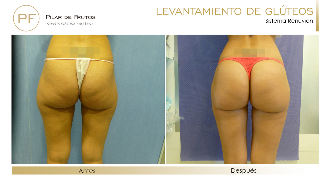 Elevacion de gluteos con renuvion antes y despues