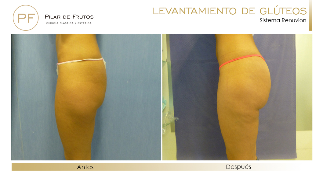 Elevacion de gluteos con renuvion antes y despues Elevacion de gluteos con renuvion antes y despues