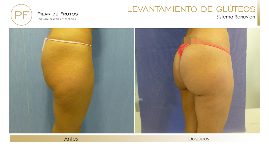 Elevacion de gluteos con renuvion antes y despues Elevacion de gluteos con renuvion antes y despues