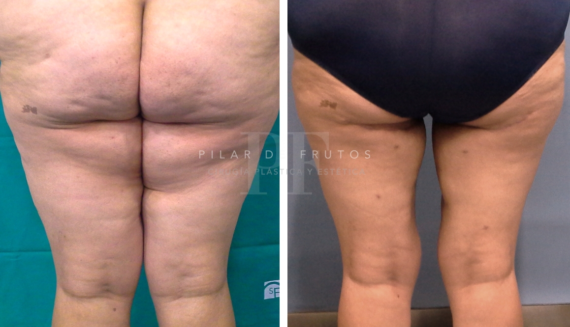 Fotos de Lifting Brazos y piernas antes y después Fotos de Lifting Brazos y piernas antes y después