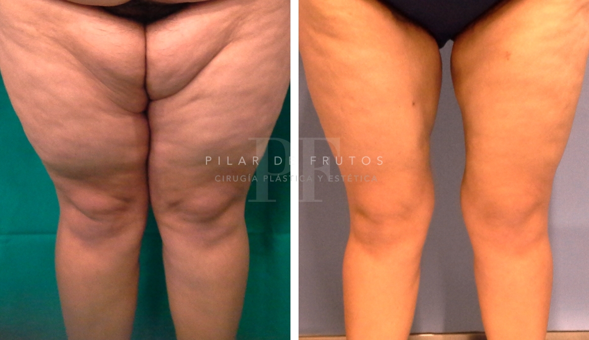 Fotos de Lifting Brazos y piernas antes y después Fotos de Lifting Brazos y piernas antes y después