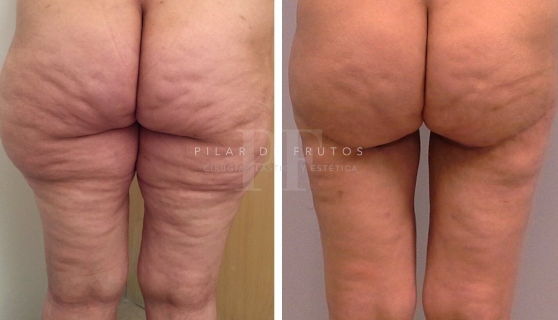 Fotos de Lifting Brazos y piernas antes y después Fotos de Lifting Brazos y piernas antes y después