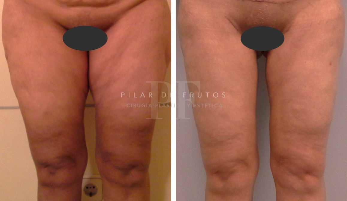 Fotos de Lifting Brazos y piernas antes y después Fotos de Lifting Brazos y piernas antes y después