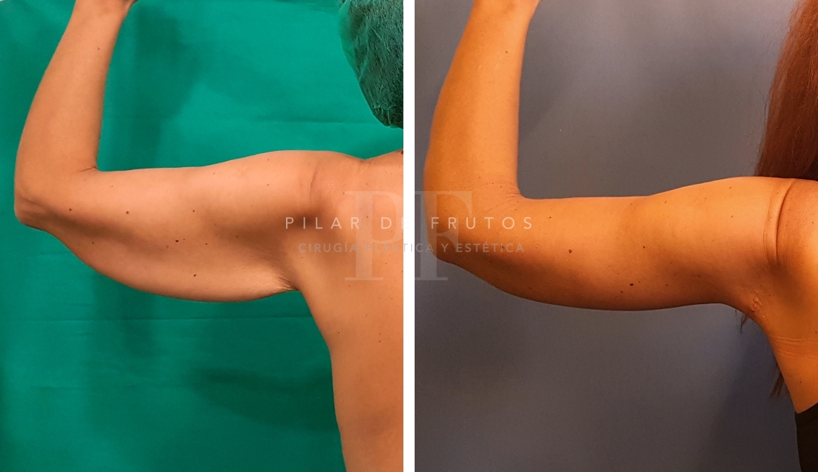 Fotos de Lifting Brazos y piernas antes y después Fotos de Lifting Brazos y piernas antes y después