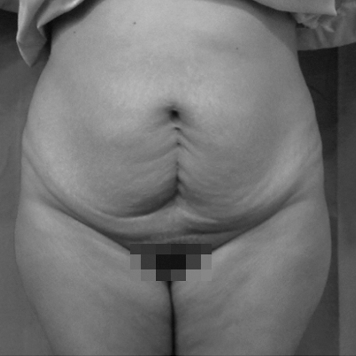 Fotos de Abdominoplastia Antes