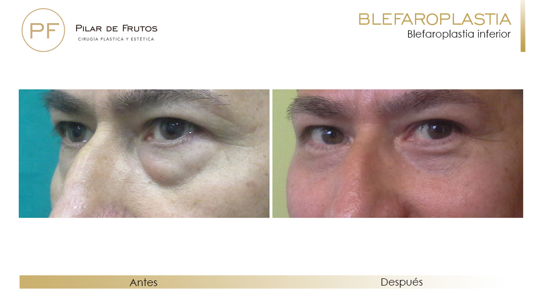 Fotos de Blefaroplastia antes y después Fotos de Blefaroplastia antes y después